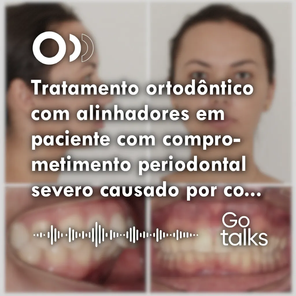 Tratamento ortodôntico com alinhadores em paciente com comprometimento periodontal severo causado por contenção tipo barra 3x3 higiênica: relato de caso