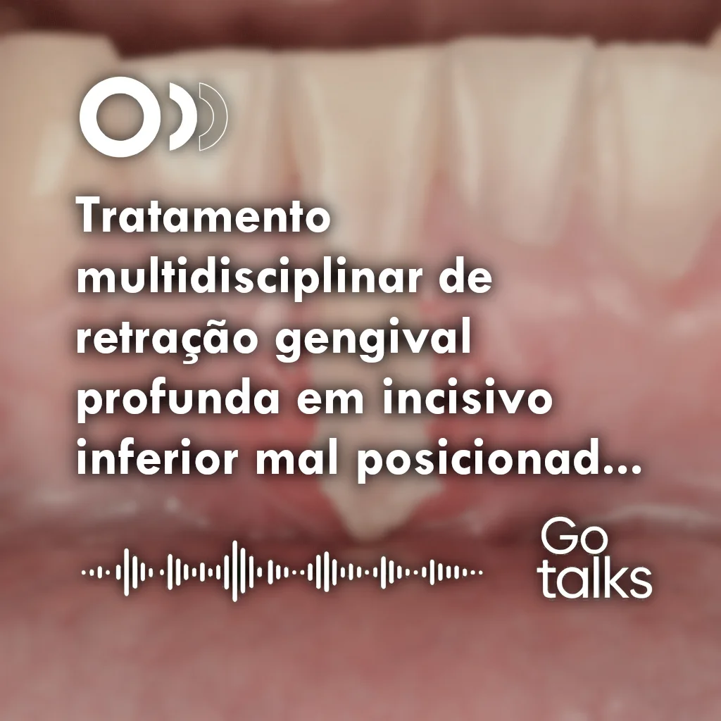 Tratamento multidisciplinar de retração gengival profunda em incisivo inferior mal posicionado: relato de caso