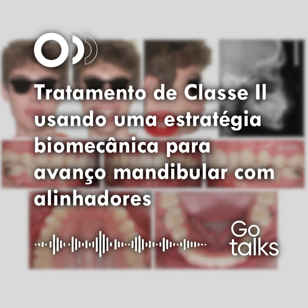 Tratamento de Classe Il usando uma estratégia biomecânica para avanço mandibular com alinhadores