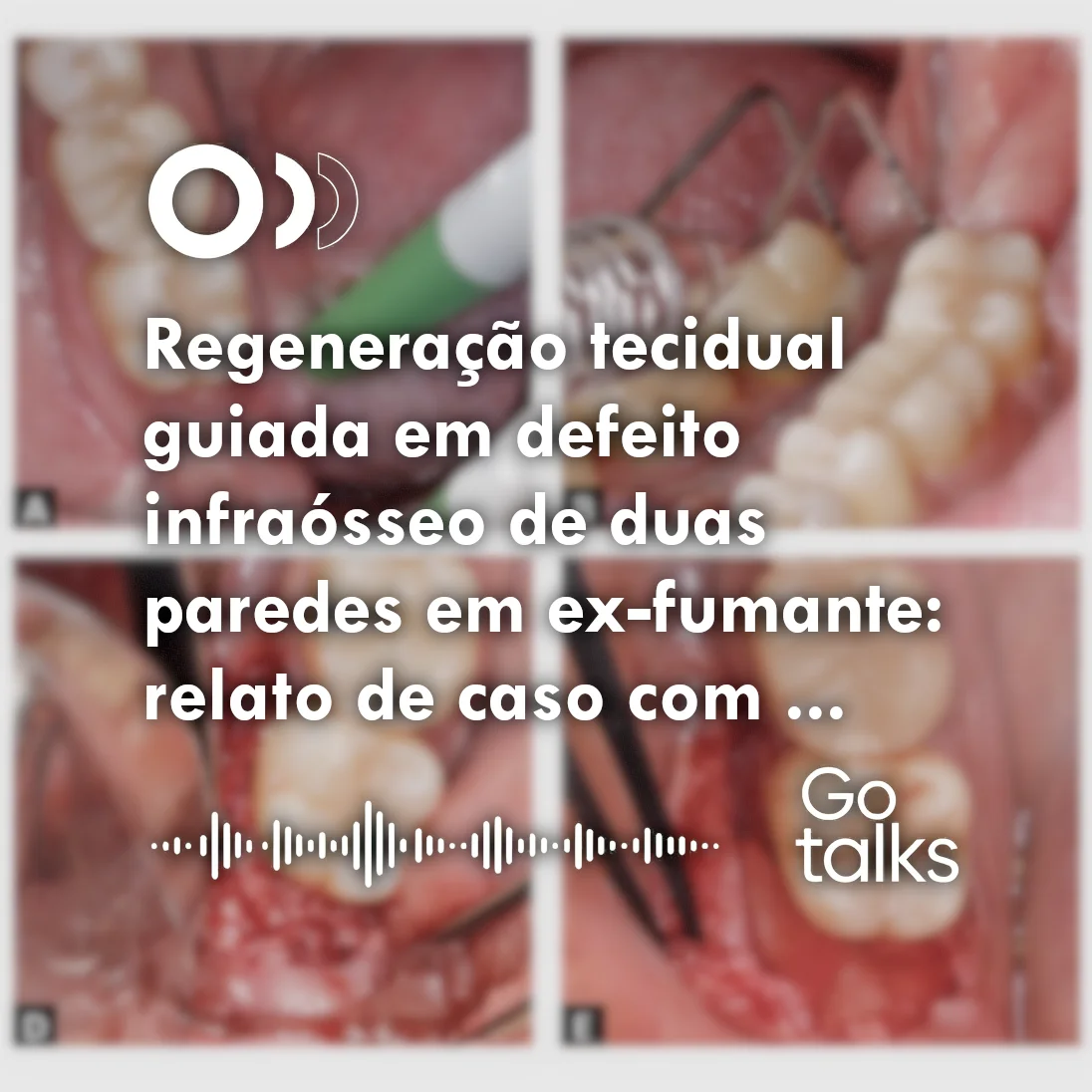 Regeneração tecidual guiada em defeito infraósseo de duas paredes em ex-fumante: relato de caso com avaliação clínica e radiográfica após seis meses